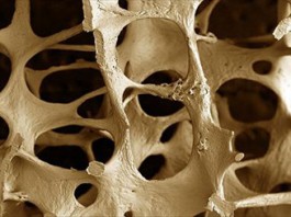 OSTEOPOROSI: LUNEDI’ 20 OTTOBRE GIORNATA MONDIALE, VISITE AL POLICLINICO