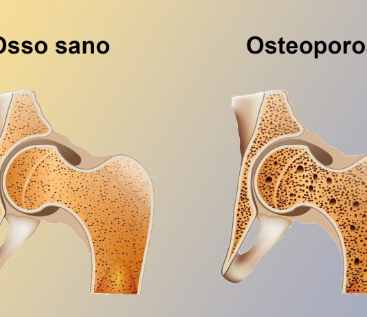 Medicina. 560 mila siciliane affette da osteoporosi, arriva una campagna per prevenire le fratture