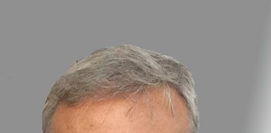 Giacomo Oteri eletto Presidente della Società Italiana di Chirurgia Odontostomatologica